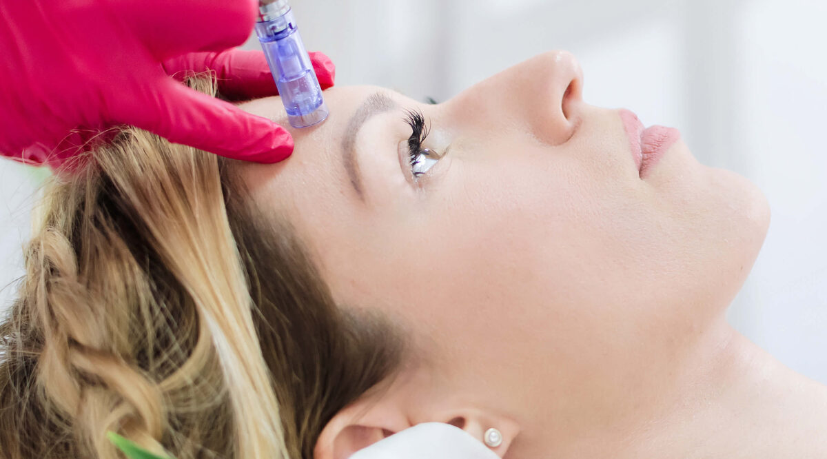 Dermapen – mezoterapia mikroigłowa